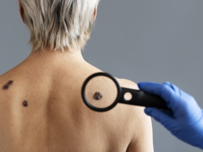 Zduńska Wola: profilaktyczne badania pod kątem czerniaka w centrum Karsznic. W planach kolejne takie akcje