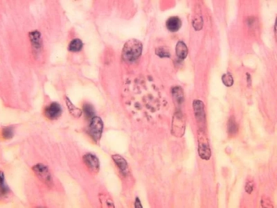 „Choroba całujących pluskiew” rozprzestrzenia się. Zarażonych 280 tys. osób?