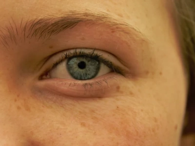 Wszystko na temat plastyki powiek górnych i dolnych