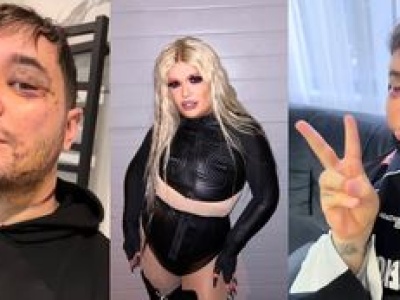 Drag queen Filo relacjonuje pierwszą operację plastyczną w Turcji. 