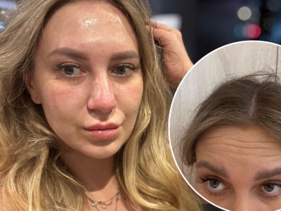 Uległam azjatyckiej obsesji piękna i zrobiłam botoks. Jak wyszło?