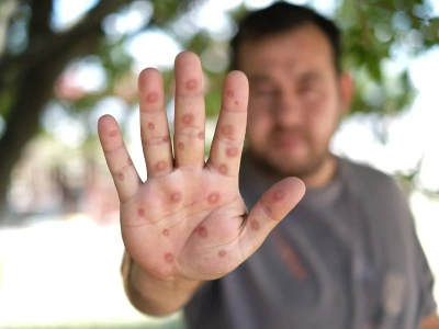 Ospa wietrzna to jedna z najbardziej zaraźliwych chorób. Kto powinien się zaszczepić?