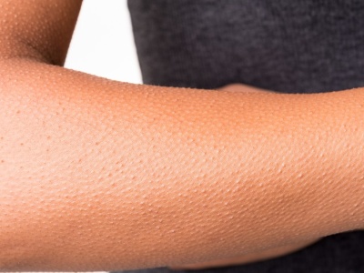 Sekrety gęsiej skórki. Dlaczego ciało dostaje ciarek?