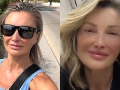 Zafundowała sobie nową twarz w tureckiej klinice. Trudno uwierzyć, ILE MA LAT. Zgadniecie?