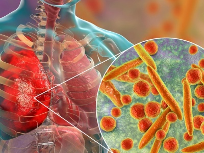 Ta bakteria atakuje coraz częściej. Lekarze biją na alarm. 