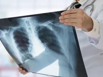 To największy na świecie zakaźny zabójca. 1,23 mln zgonów w 2024 r.