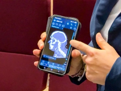 Rewolucja w leczeniu udarów na Dolnym Śląsku