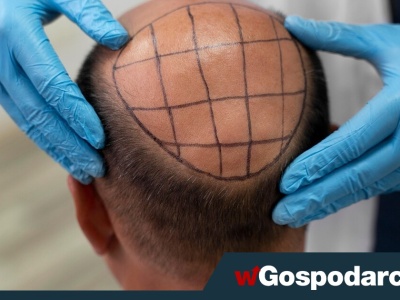 Przeszczep włosów. 