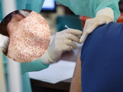 Ognisko odry na Podkarpaciu coraz większe. Sanepid potwierdza kolejne zachorowania