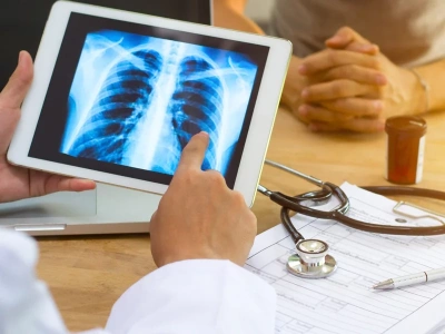 Rak płuca. Nowy program wczesnego wykrywania choroby na NFZ