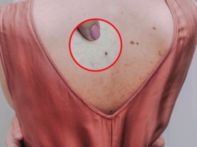 Na twoim ciele pojawiły się 