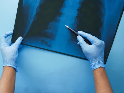 Czas podania immunochemioterapii a przeżycie w ES-SCLC. Poranne wlewy są skuteczniejsze