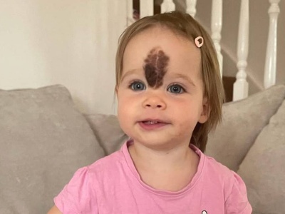 Urodziła się z wielkim znamieniem na czole. Lekarze odmówili operacji. Tak dziś wygląda