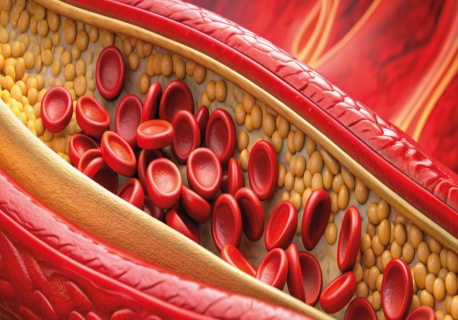 Miażdżyca jako proces zapalny