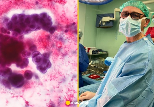 Jak zaczyna się rak? Dr Hać: musi dojść do trzech zdarzeń, zawsze