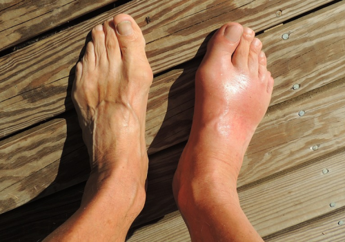 Sześć naturalnych sposobów na walkę z dną moczanową, „chorobą królów”