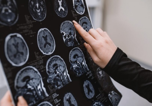 Guz mózgu po leku antykoncepcyjnym dostępnym w UK, Irlandii i Polsce