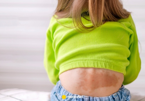 Przełom w leczeniu dokuczliwej choroby u dzieci. Pierwsze takie zabiegi wykonano w Polsce