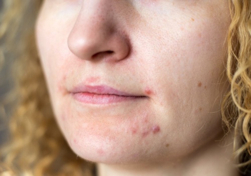 Herbaty, które działają od środka okiem ekspertki. Na trądzik, stany zapalne i skoki cukru.