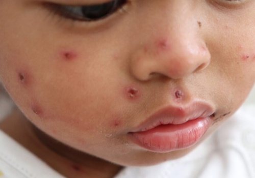 Zapomniana choroba uderza w Londyn. Ostrzeżenie dla całej Europy