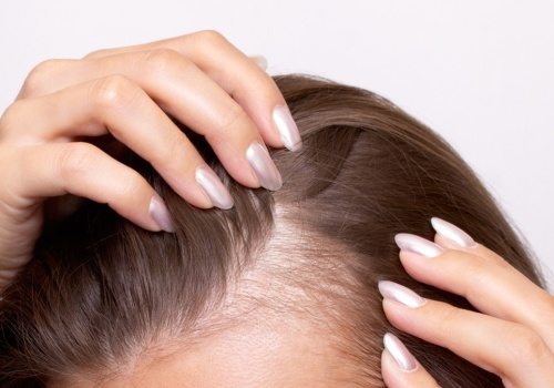 Włos się jeży - problemy na głowie