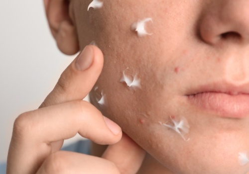 Wypryski, zaczerwienienie i zmiany bakteryjne znikną. Są z apteki bez recepty