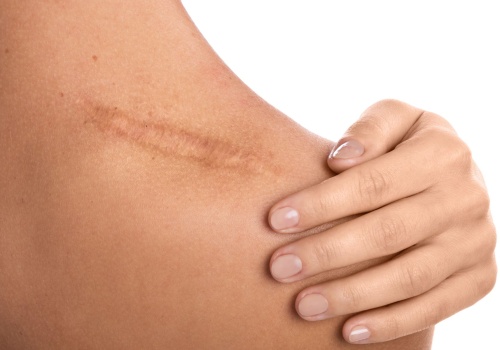 Skóra po przejściach, czyli jak skutecznie usuwać blizny i zgrubienia?