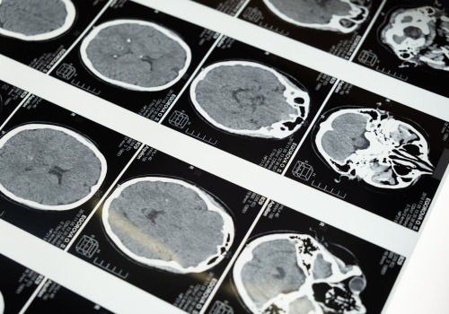 Czy można odmłodzić mózg? Zmodyfikowana terapia immunologiczna poprawia pamięć u myszy