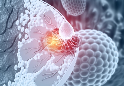 Przełom w chirurgii raka piersi. Pacjentki są zachwycone