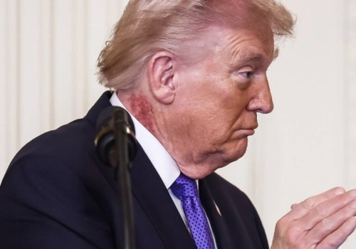 Wysypka na szyi Donalda Trumpa. Lekarz prezydenta wyjaśnia przyczynę