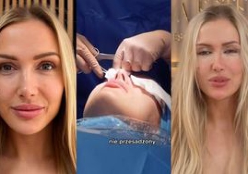 Eliza Trybała relacjonuje wizytę w klinice, w której sprawiła sobie PLASTYKĘ POWIEK: 