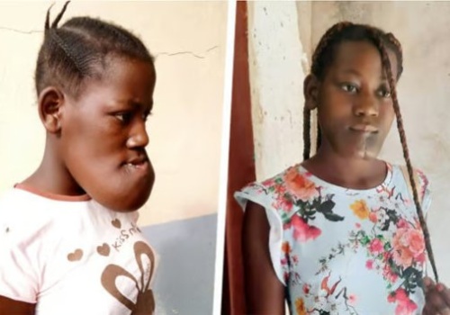 Olsztyńscy lekarze ponownie pomogą 17-letniej Cristinie z Angoli. Trwa zbiórka środków