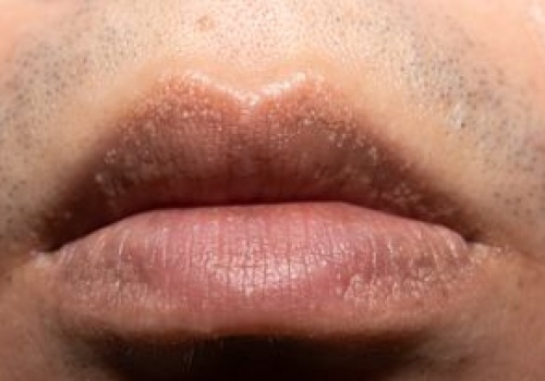 Białe plamki na wargach? Nie zawsze to tylko problem kosmetyczny