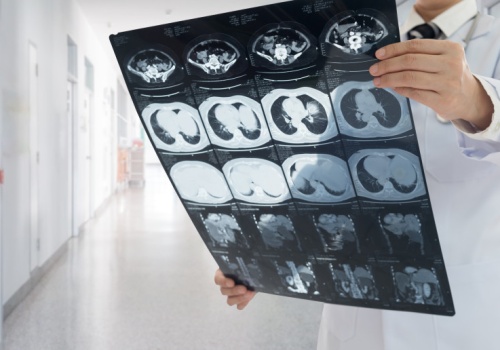 5 lat wystarczyło, by całkowicie cofnąć marskość wątroby. Jedna zmiana