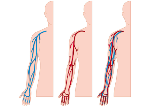 GUZKOWE ZAPALENIE TĘTNIC