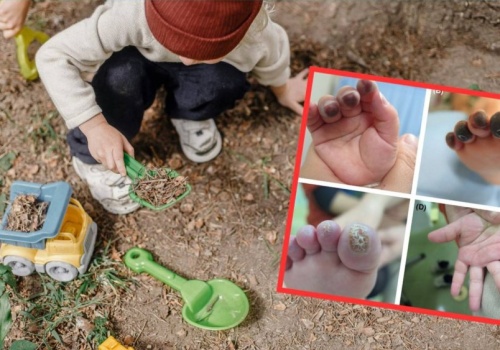 Palce 2-latka zaczęły sinieć po zabawie na zimnie. Rodzice byli przerażeni tym, co zobaczyli