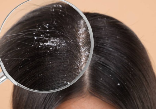 Ten szampon to likwidator łupieżu! Błyskawicznie pozbędziesz się białych płatków