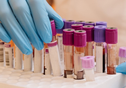 Zrobiony przed badaniem może wpłynąć na wyniki. Wrażliwy zwłaszcza cukier i hormony