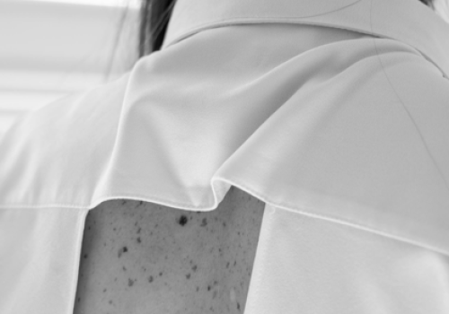 Łupież pstry - czy jest zaraźliwy?