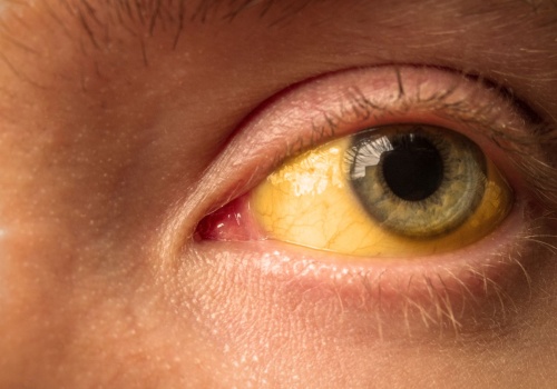 Żółte oczy, jakie mogą być przyczyny? Czego objawem są żółte białka oczu?  