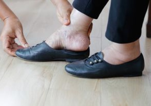 Pięta Haglunda to problem nie tylko estetyczny. Dotyka takich kobiet