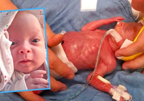 Cud w Opolu! Pola ważyła 450 gramów, a wygrała walkę o życie