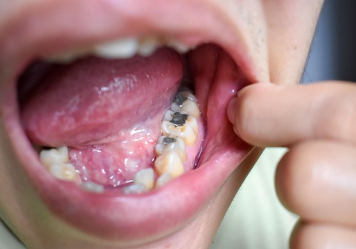 NHS nadal stosuje plomby amalgamatowe. Polacy w UK oburzeni