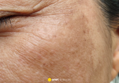 Ten nowy killer przebarwień maksymalnie rozjaśnia plamki. Efekt porcelanowej skóry