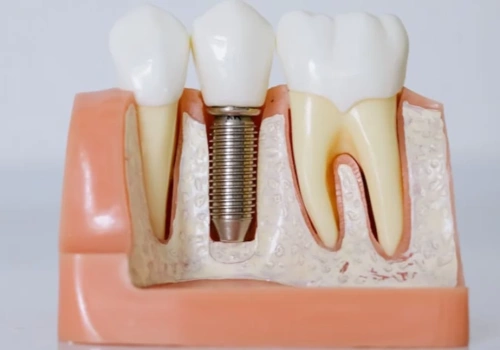 Implanty zębowe na Śląsku - co pacjent powinien wiedzieć przed podjęciem decyzji