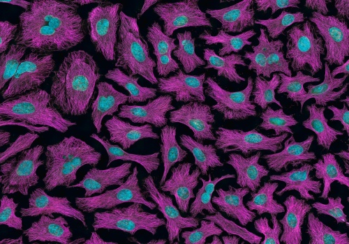 Komórki odpowiedzialne za powstawanie przerzutów u chorych na raka piersi pod lupą naukowców