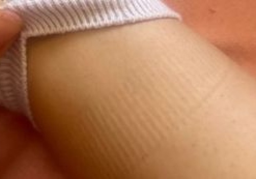 Widzisz takie ślady na nogach? To sygnał alarmowy