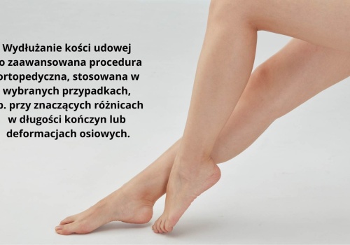 Wydłużanie kości udowej – co warto wiedzieć przed decyzją o zabiegu