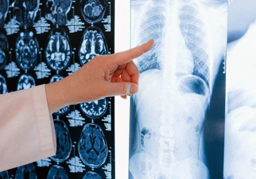 Wirtualne guzy raka płuca pomagają szukać nowych kombinacji leczenia