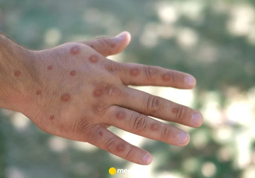 Wzrost zakażeń małpią ospą o 140 procent. GIS apeluje o ostrożność